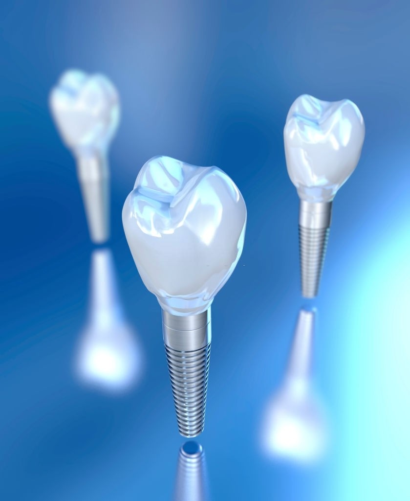 3d illustration of three tooth implants